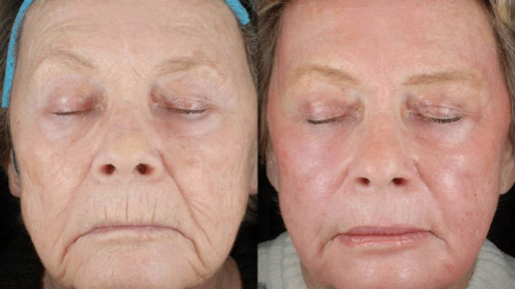 Before and After PRP Treatment